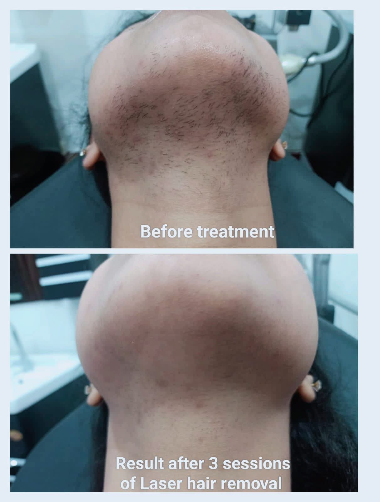 Laser Hair Removal Chin and Submental Area Before and After 3 Sessions at CosmoDent