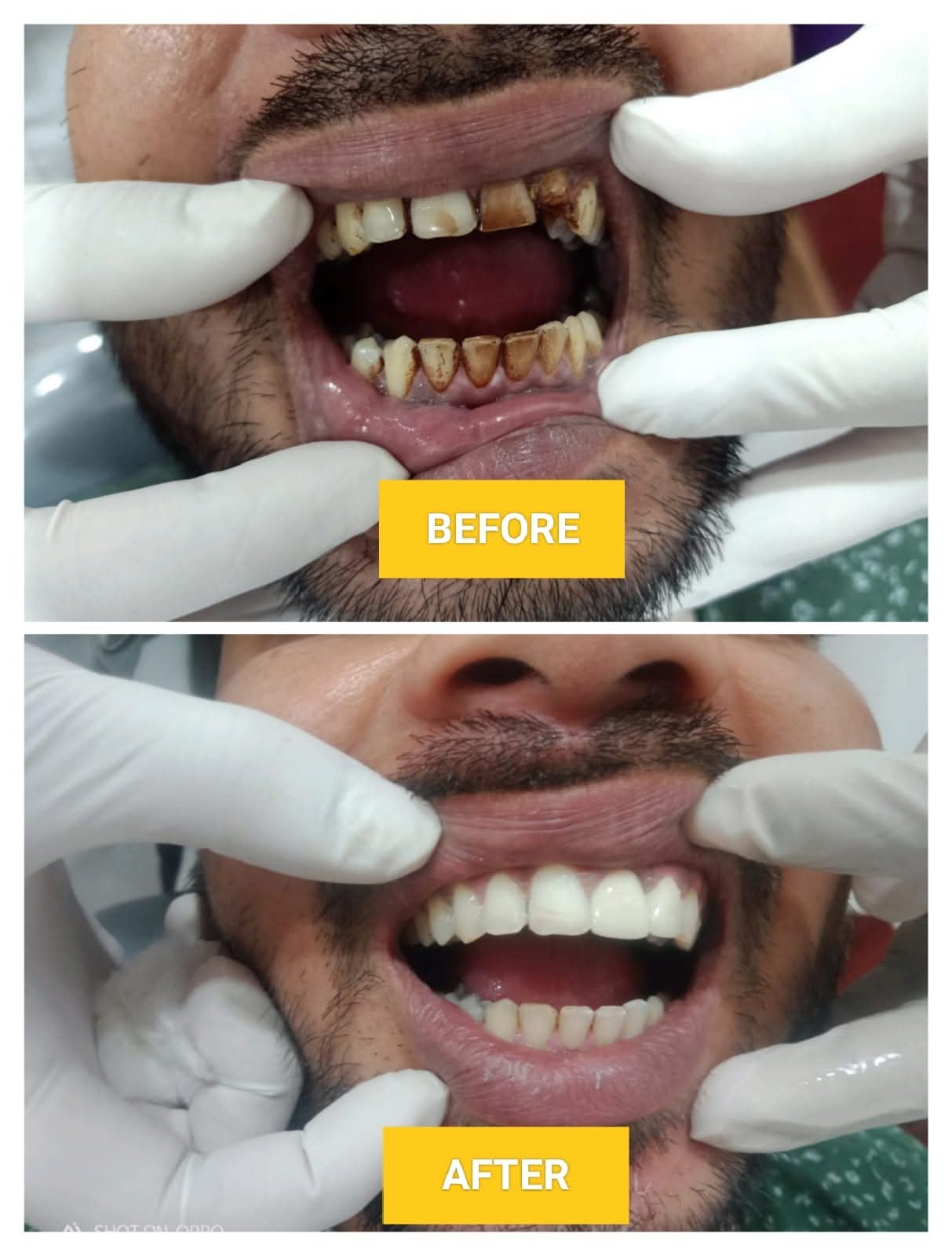 Comprehensive Anterior Aesthetic Smile Reconstruction Before and After at CosmoDent