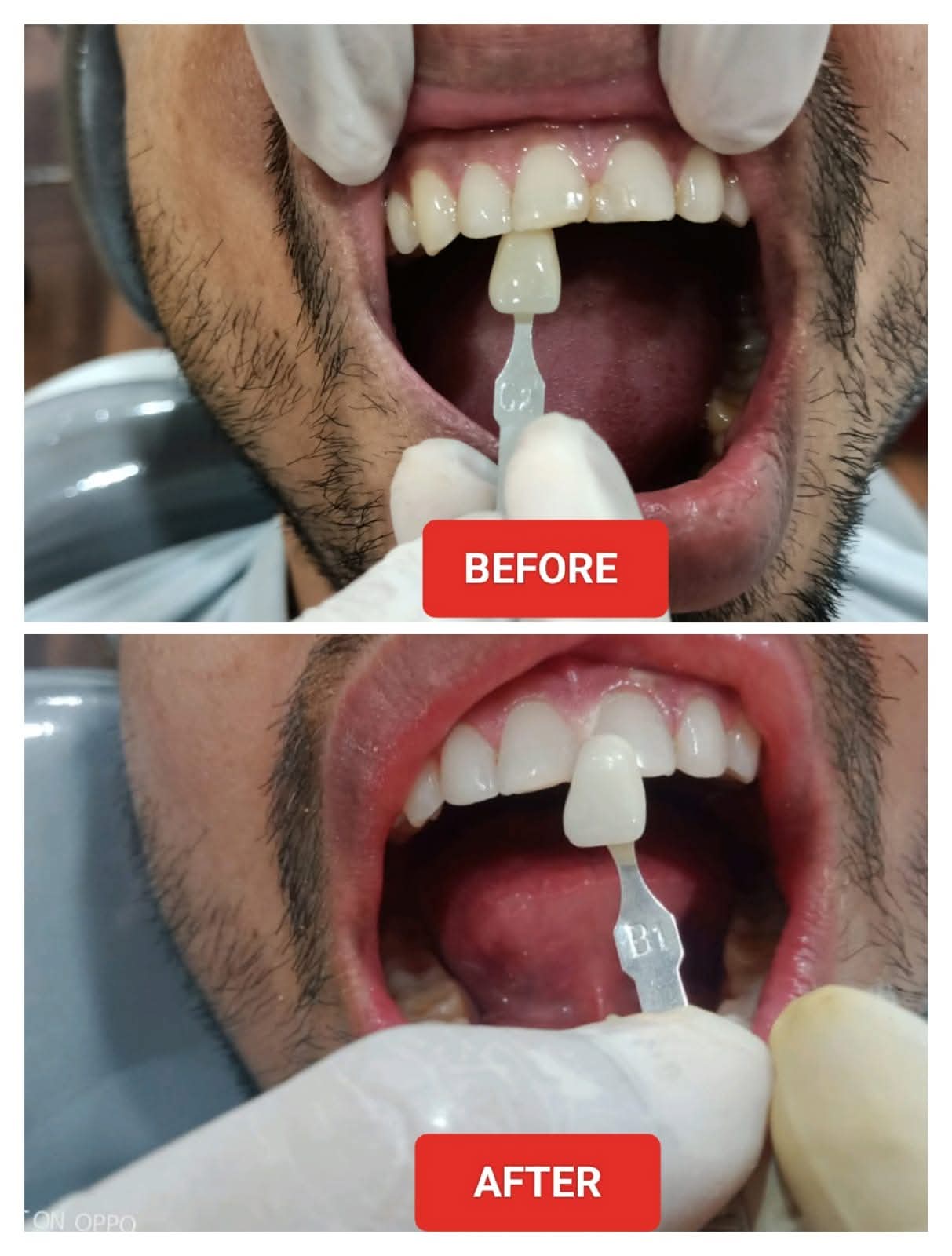 In-Clinic Teeth Whitening Shade C2 to B1 Before and After at CosmoDent