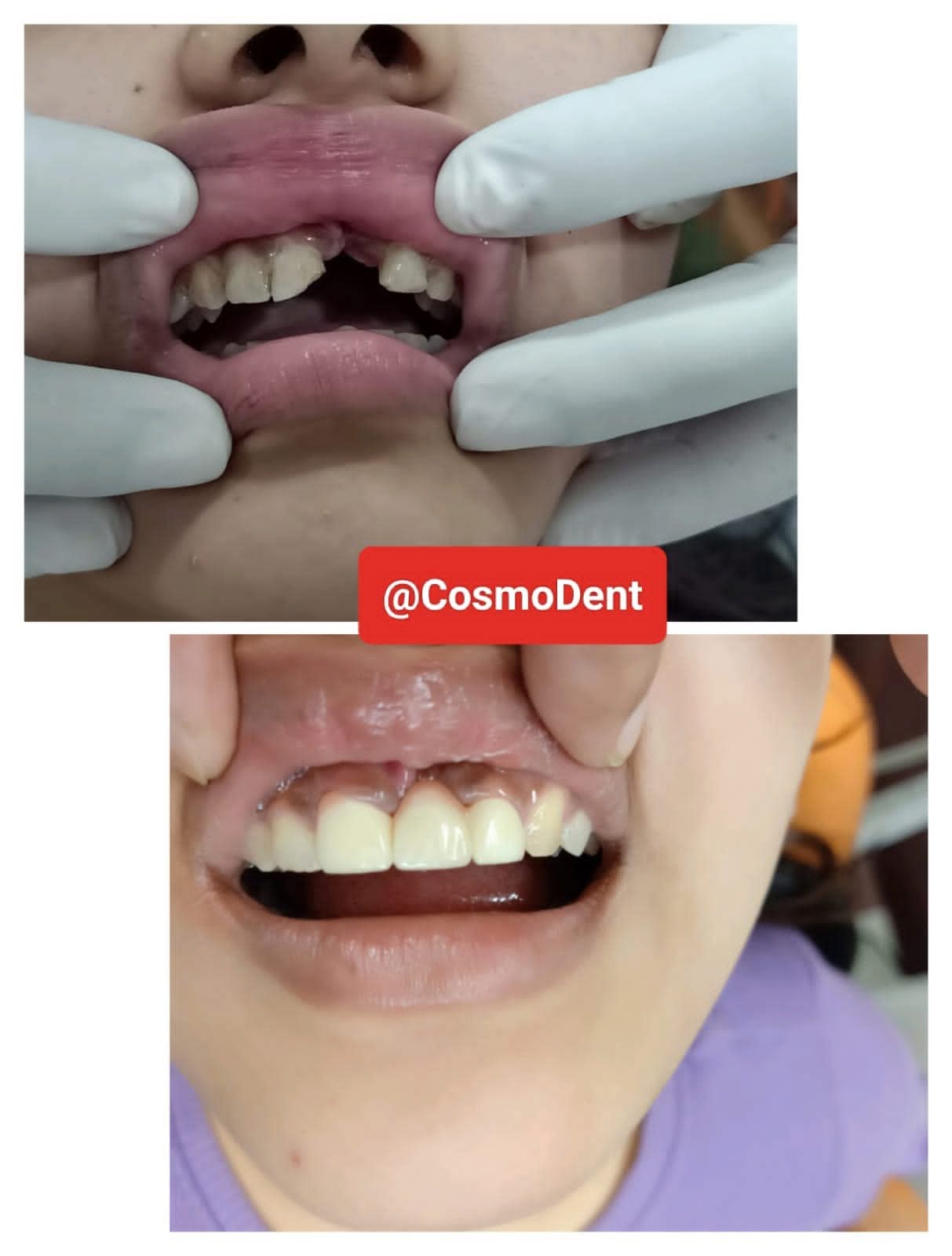 Pediatric Anterior Tooth Trauma and Crown Reconstruction Before and After at CosmoDent