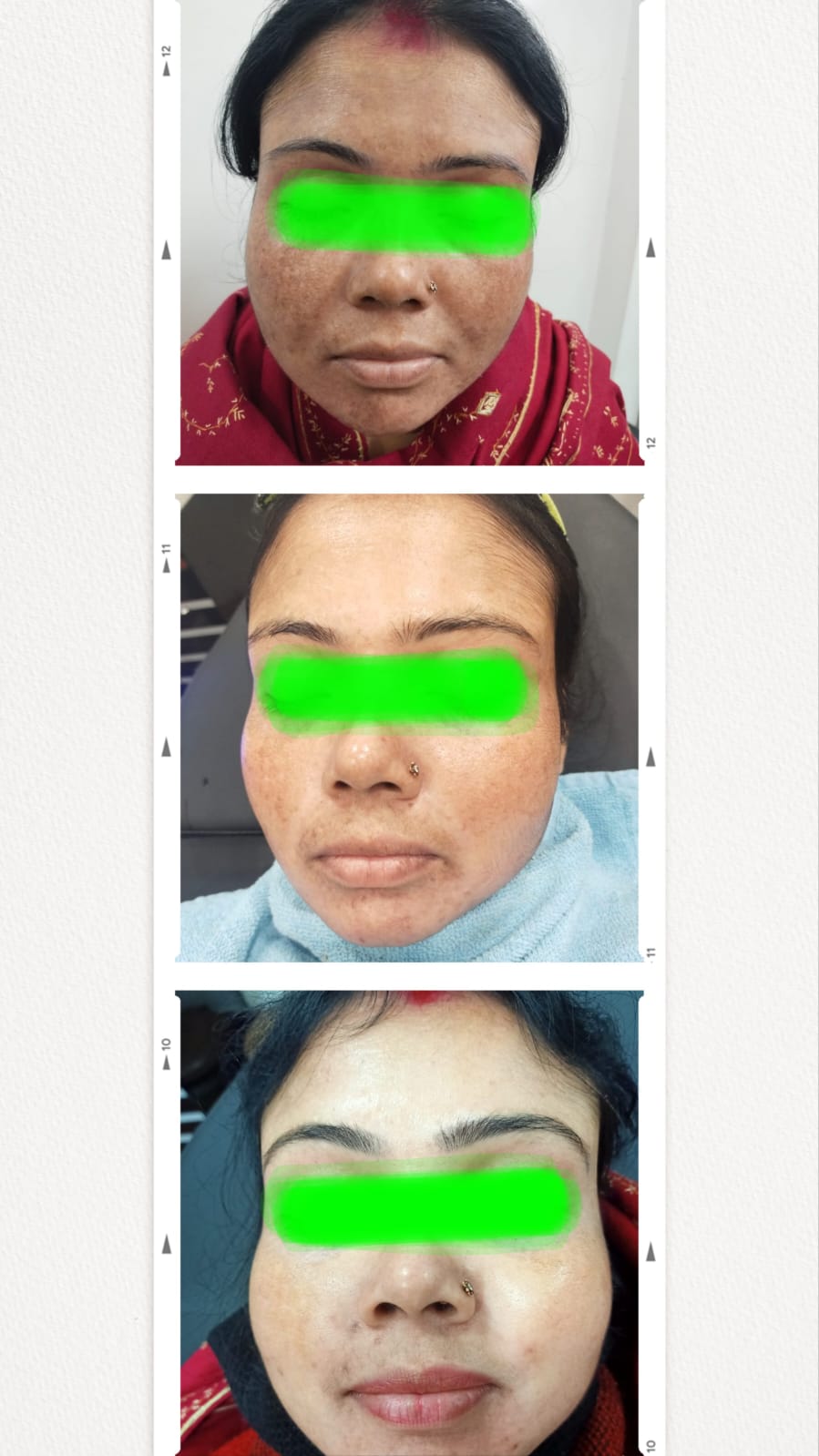 Laser Toning for Melasma and Pigmentation Before and After at CosmoDent