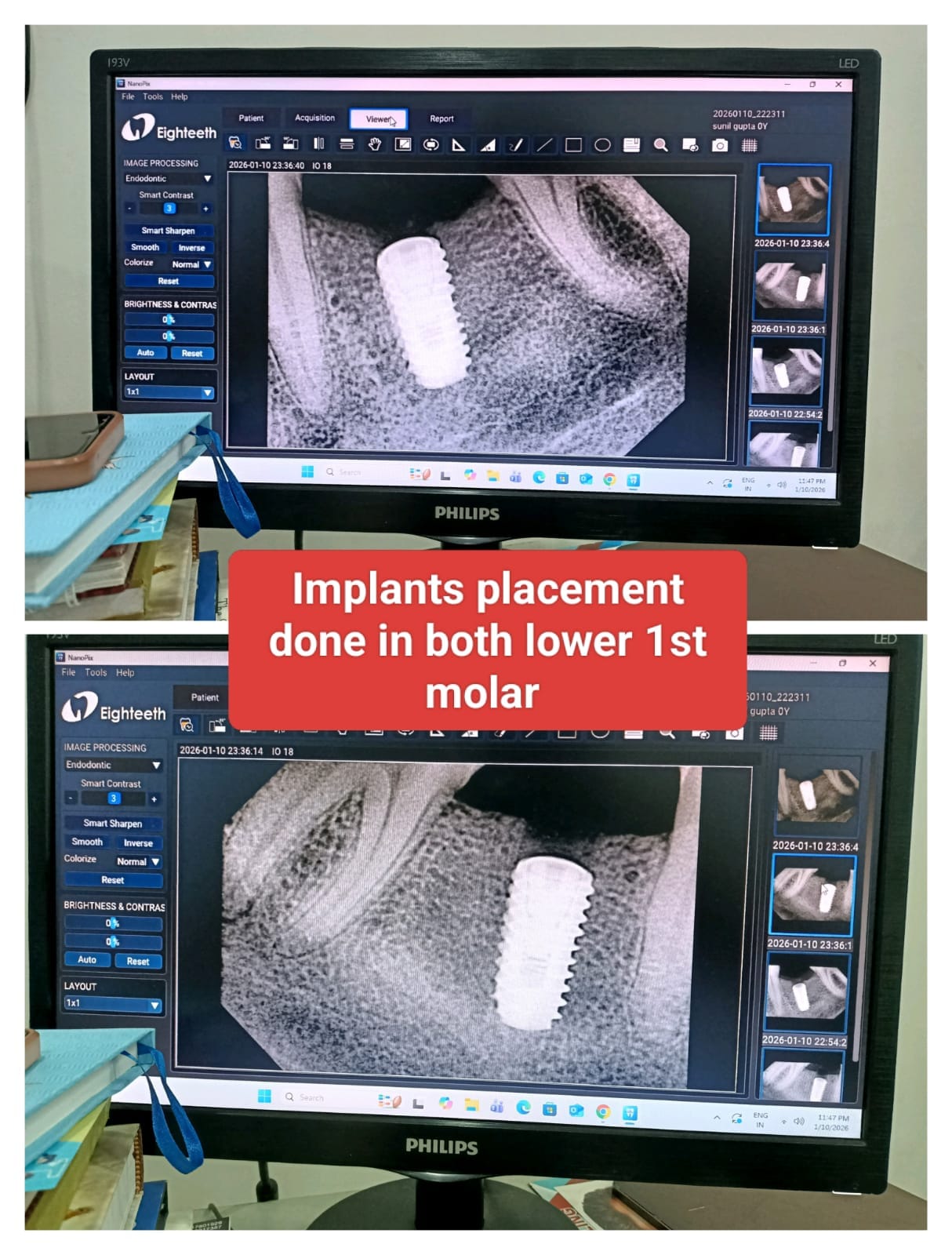 Bilateral Lower 1st Molar Dental Implant Placement Digital Radiography at CosmoDent