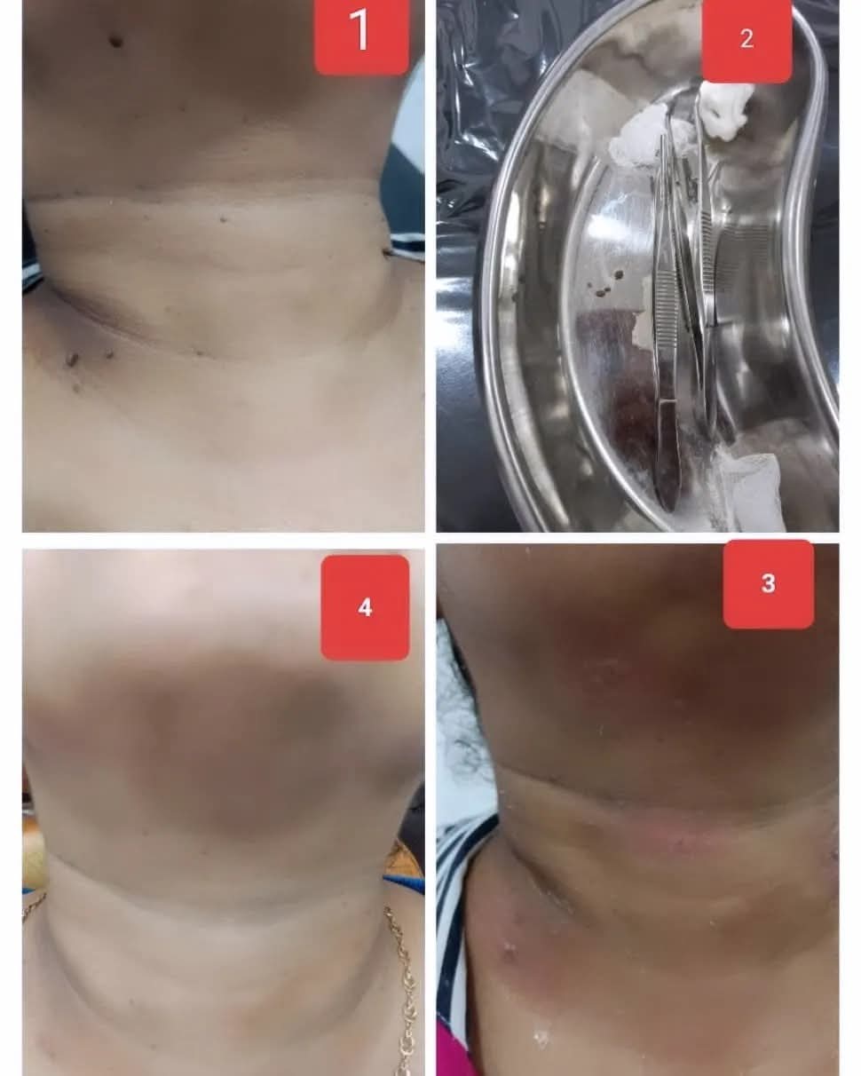 Skin Tag and Lesion Removal Before and Healed Result at CosmoDent