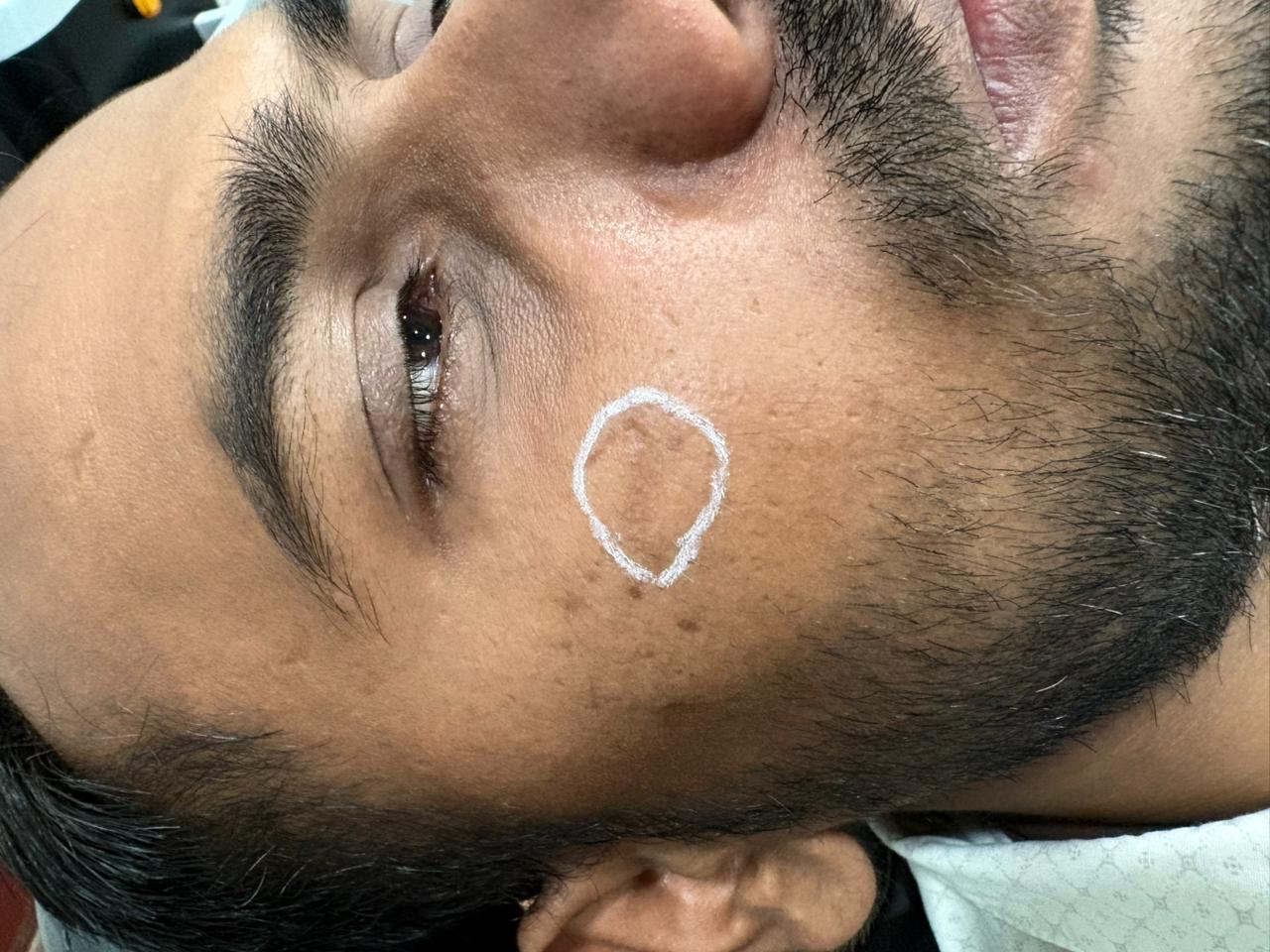 Facial Scar Assessment and Targeted Resurfacing at CosmoDent